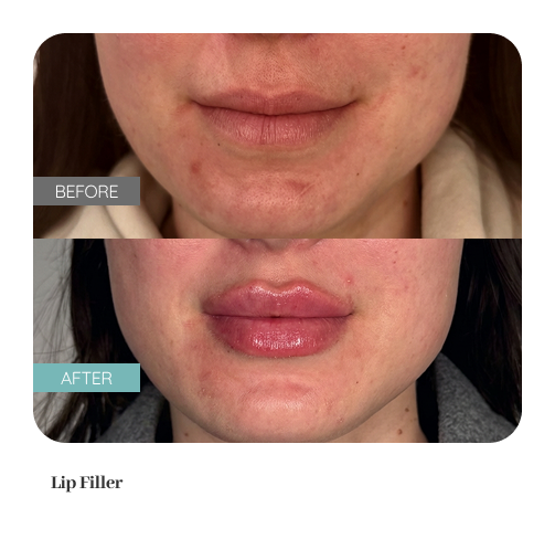 Before and after treatment result — Dr. Lanna, LC Medical Aesthetics NYC